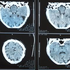 Brain scan